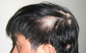 Hair Fixing Services in Delhi NCR India